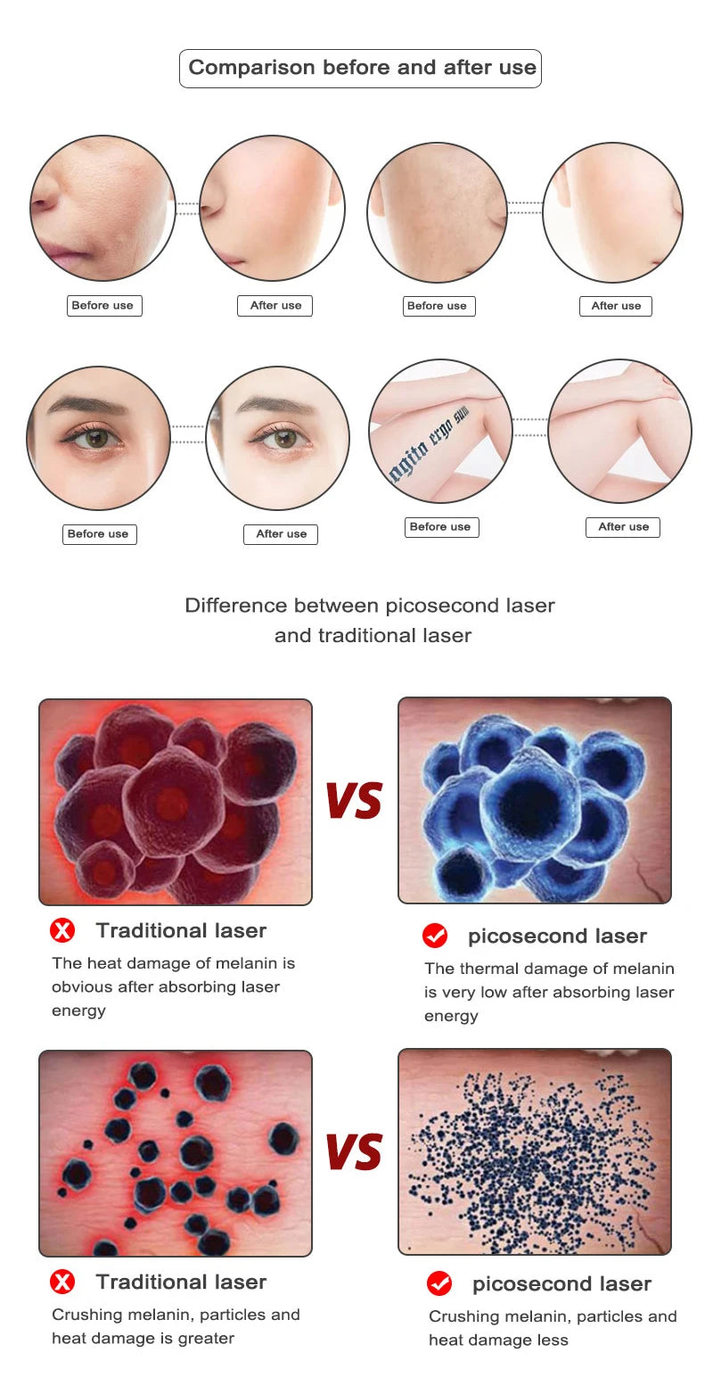 Pikosekunden-Laserpointer zur Entfernung von Maulwurfs, Stift zur Entfernung dunkler Flecken, Tattoo, Akne, Hautpigment, tragbare Entfernungsmaschine, Schönheitsgerät